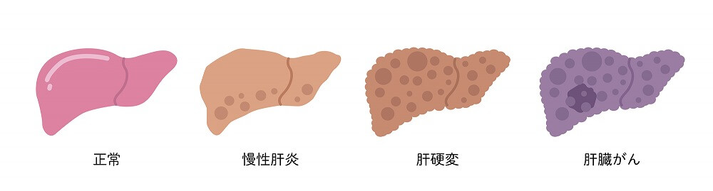 脂肪肝が進行すると…