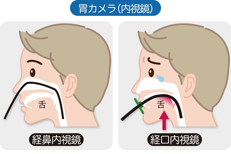 苦痛の少ない経鼻内視鏡を採用しております